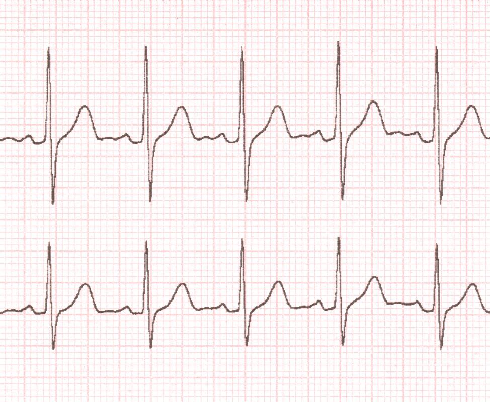 Some ECG machines use a paper-strip recorder to display readings.