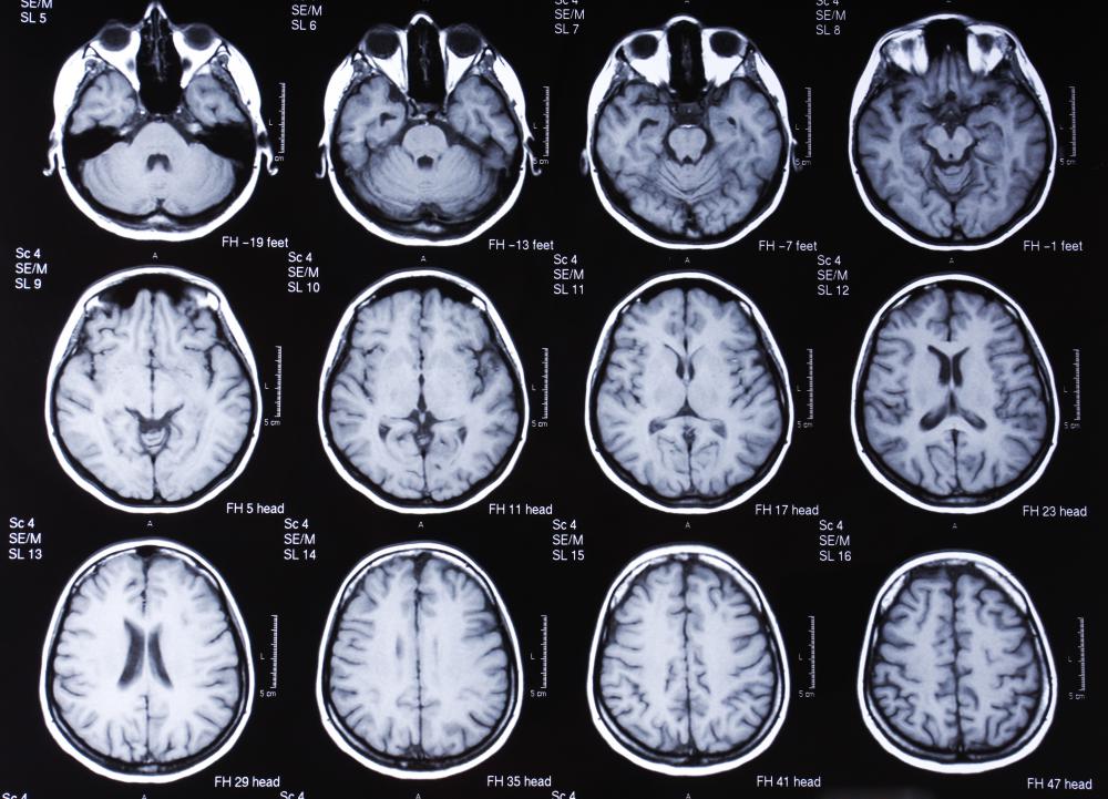A MRI scan of the brain.