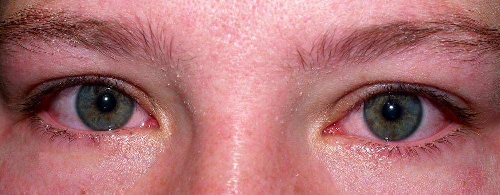 The potassium hydroxide inside alkaline batteries can cause eye irritation.