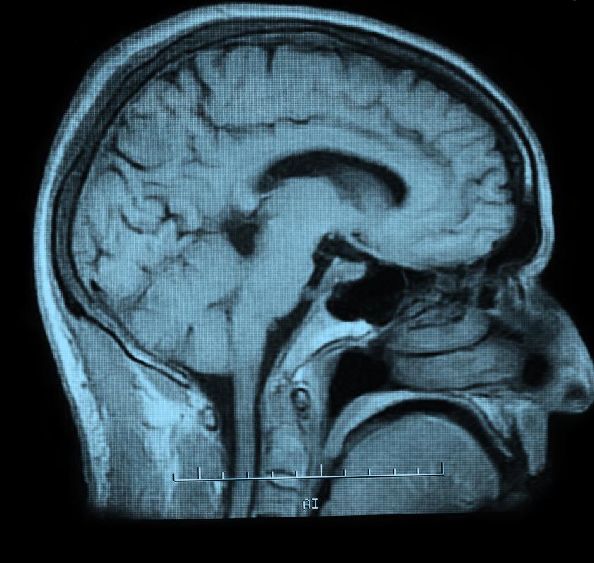 MRI's of the brain have allowed scientists to map the brain in new ways.