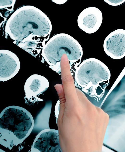 Brain MRIs are important to both researchers and medical doctors.