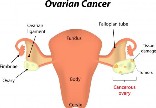 SAW resonators may be able to be used as an early detection device for ovarian cancer.