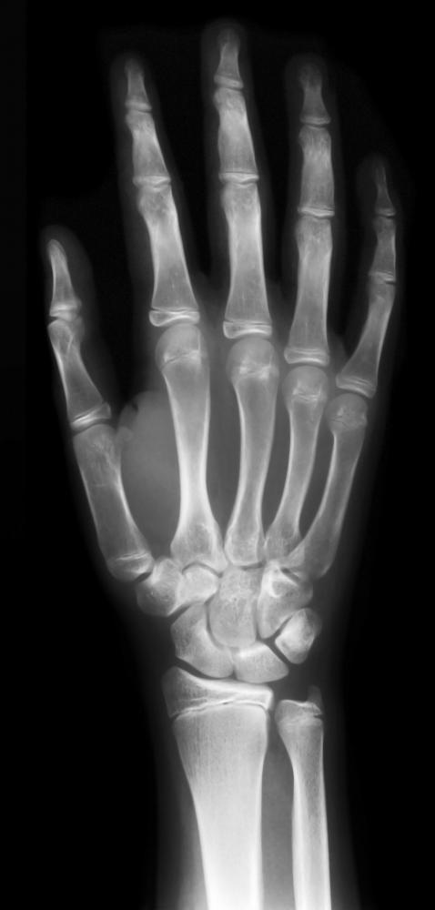 An X-ray of a hand.