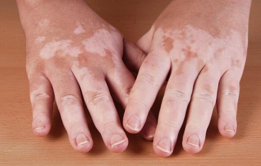 UV-B treatments may help patients with vitiligo.